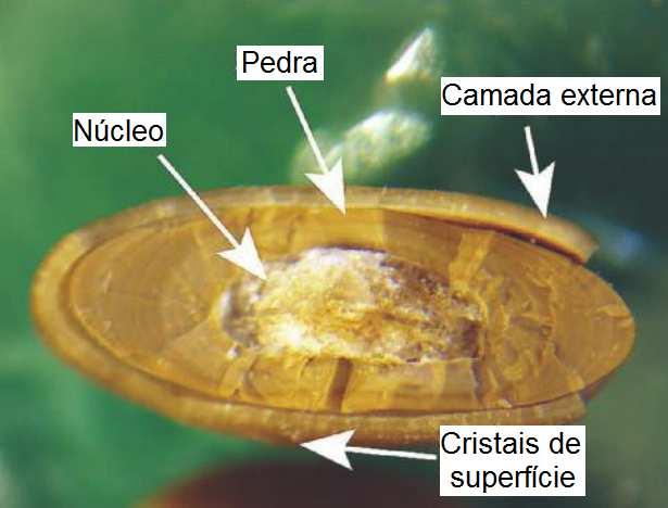 Figura 2: Anatomia de um urólito de urato composto com um núcleo de estruvita e uma camada externa de oxalato de cálcio. Fonte: Adatado de Bartges e Polzin, 2011.