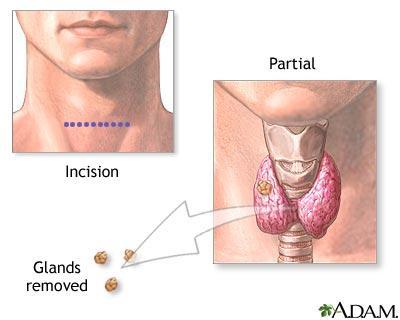 Paratireoidismo Primário Adenoma Hiperplasia
