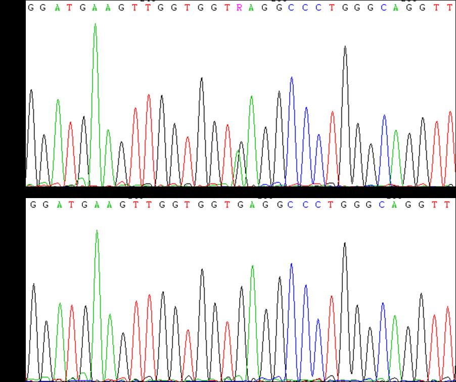Figura 33. Sequenciação do gene HBA2 dos indivíduos A28, A29 e A30. Apresentam a deleção/ substituição também designada patchwork α212. (A) Amostra; (B) Controlo normal. Figura 34.