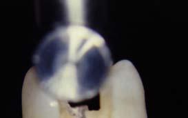 Figura 1 Aspecto da falha em pré-molares sujeitos à diferentes configurações de restauração.