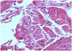 Biópsia miocárdica (hematoxilina e eosina 400X) - material eosinofílico amorfo circundando as fibras
