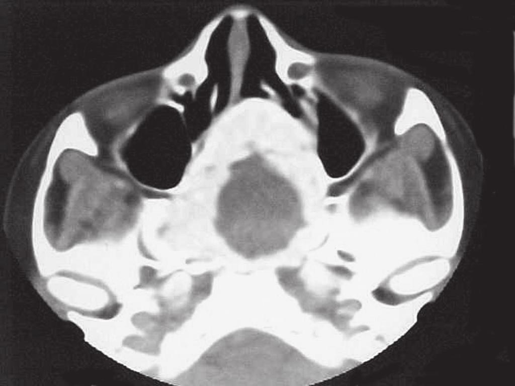 lâmina pterigoidea medial à esquerda e parede medial e superior da órbita esquerda, reduzindo a cavidade orbitária e deslocando o globo ocular para a esquerda.