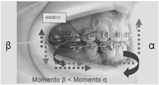 óssea. Estímulo efetivo mínimo que aciona formação óssea.