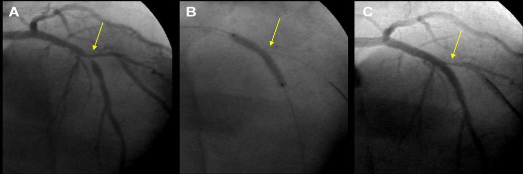 167 Figura 49. Deterioração do RL após implante de stent no VP. A Angiografia préprocedimento mostrando um lesão de bifurcação envolvendo a artéria DA e o ramo Dg.