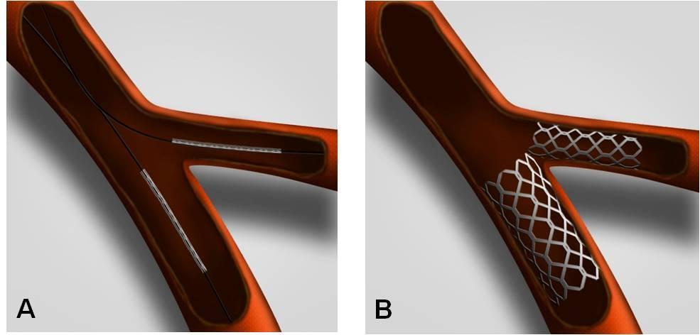 35 Figura 15. Técnica V. A posicionamento de stents nos ramos distais da bifurcação com protrusão mínima na carina; B resultado final após implante dos stents.