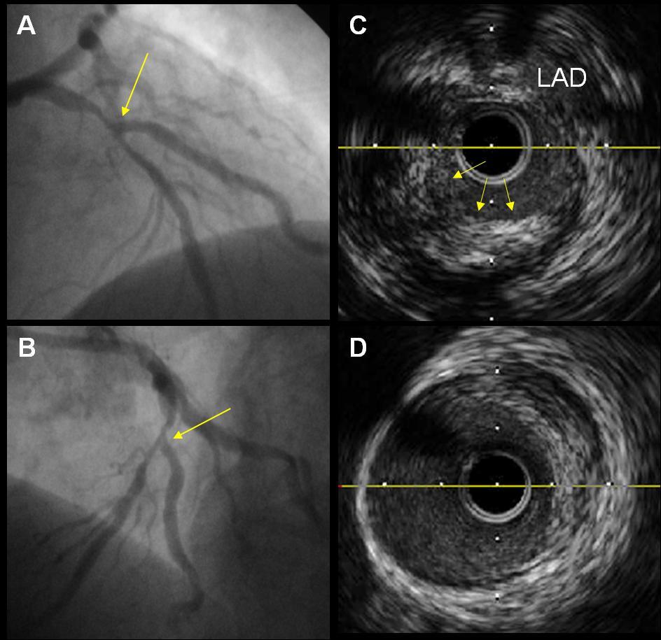 48 Figura 19. Análise de ultrassom pré-procedimento II. A e B. Angiografia de lesão de bifurcação coronária sem evidência de comprometimento do RL. C.