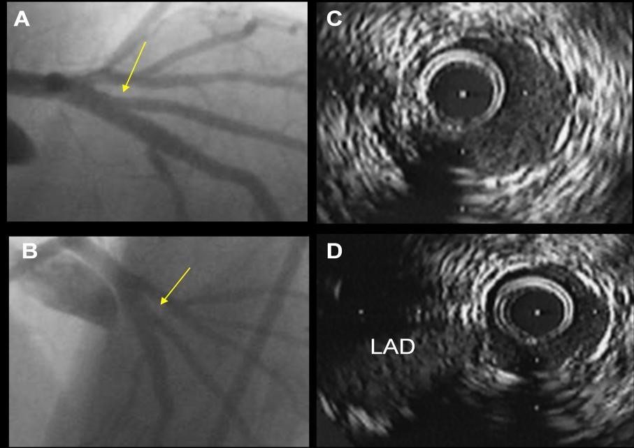 50 No geral, a área mínima do stent era localizada no óstio do RL em 68% dos casos, o stent do RL apresentava subexpansão significativa do stent (valor médio de expansão do stent: 79,9%) e a maioria