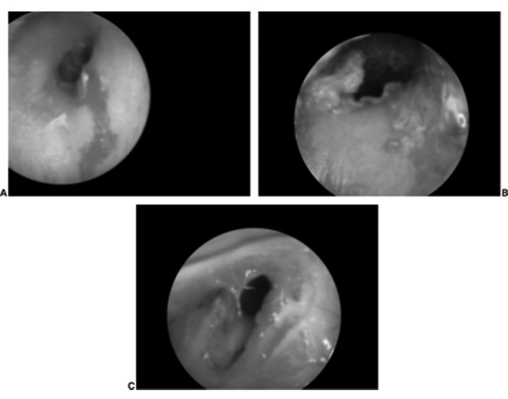 Figura 2. Laceração da pele do conduto auditivo externo. Figura 3. Otomicose associada a corpo estranho (fragmento de algodão).