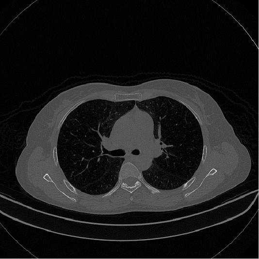 4.4 Análise do Pulmão Como o foco de aplicação escolhido para validação da abordagem principal desse trabalho foi uma análise de imagens de CT de pulmão e os parâmetros perceptuais levantados são