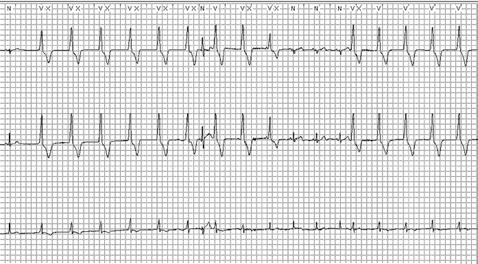 4. Parassístole Durante traçados mais longos de ECG podem observar-se complexos ectópicos ventriculares, que se apresentam como se estivessem competindo com o ritmo basal.