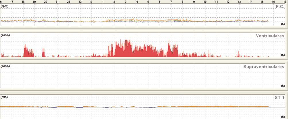 DISTRIBUIÇÃO CIRCADEANA Batendo Papo sobre Holter A descrição da distribuição da atividade ectópica ventricular durante um exame de Holter é de suma