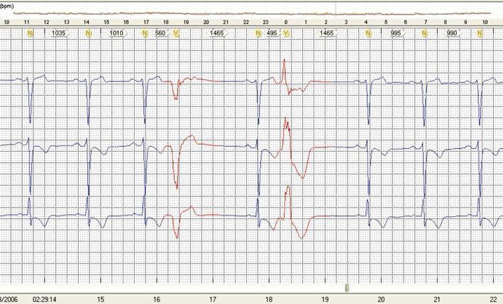 Após análise inicial das características eletrocardiográficas da EV, passaremos a quantificar a atividade ectópica, demonstrando como ela se apresenta durante a gravação.