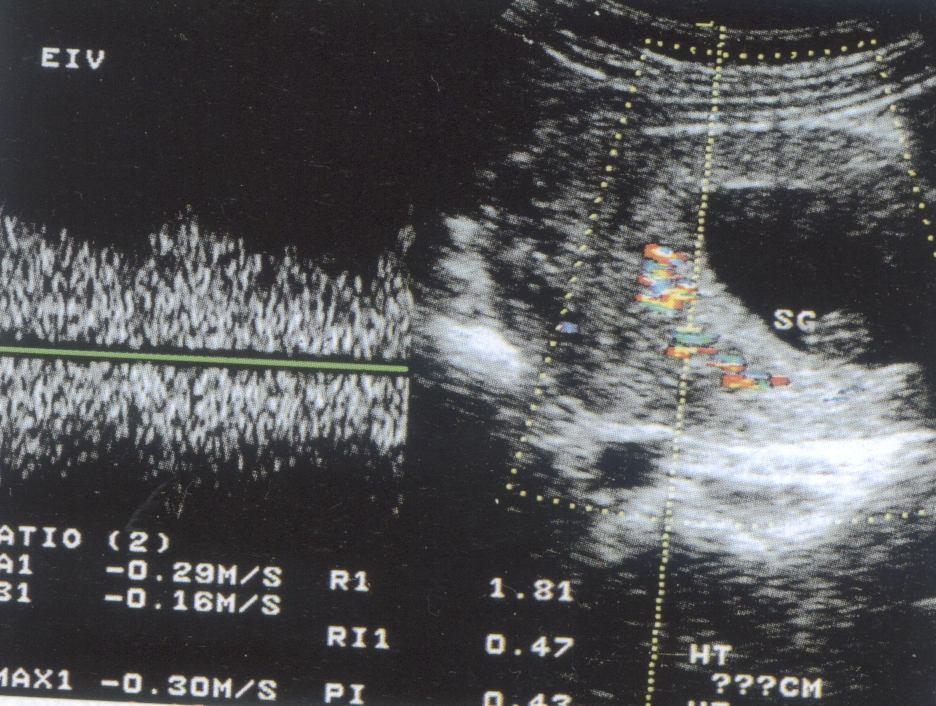 Gestação de 7 semanas. Doppler colorido transvaginal normal.