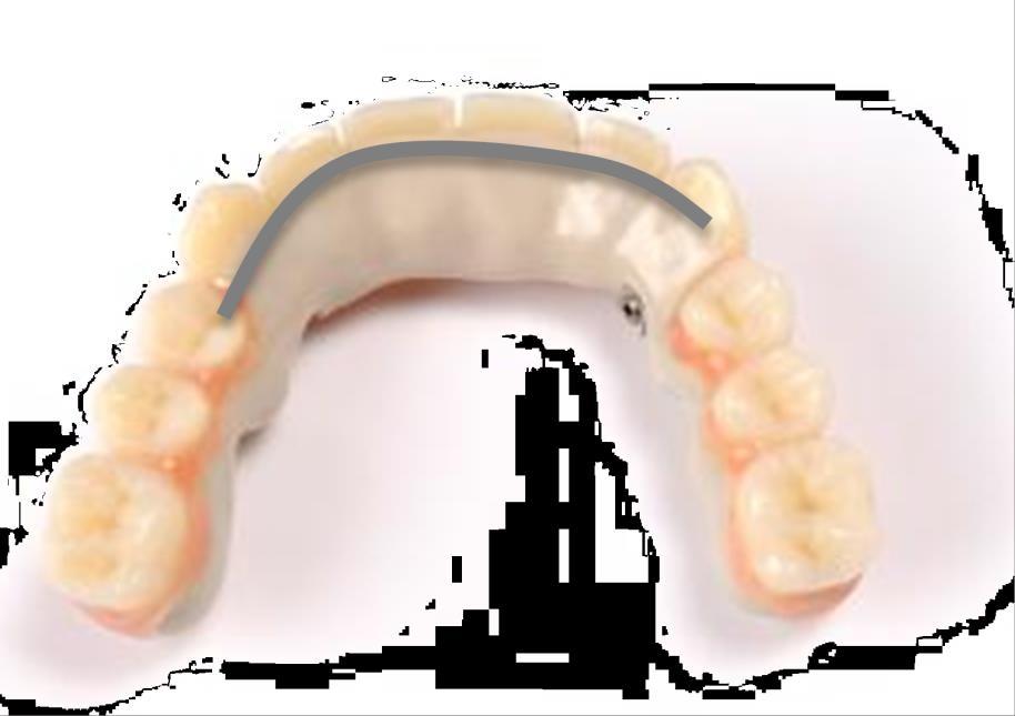 Prótese Dentária Removível com Ligações Telescópicas Prótese dentária removível com ligações telescópicas sem barra transpalatal requer o desenho de uma placa de proteção palatinal (para dentadura no