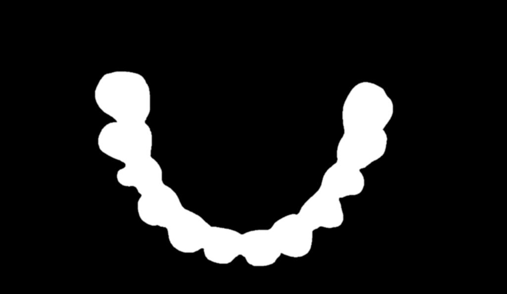 Prótese Dentária sobre Implantes Espessura Do Abutment: Espessura mínima: 1 mm Base Posterior da