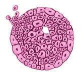 Os cânceres de mama têm muitas características que ajudam a determinar o melhor tratamento. A anormalidade nas mamas é um câncer?