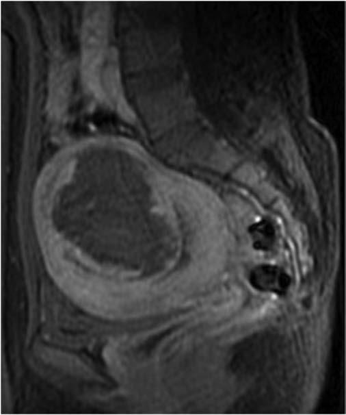 Multicenter, Double-Blind, Controlled Trial. Clinical Therapeutics 2007;29(8):1682-1691. 2. Adamson GD. Treatment of uterine fibroids: current findings with gonadotropin-releasing hormone agonistis.