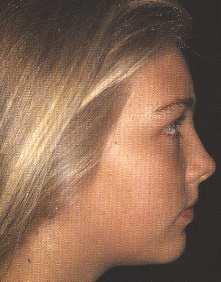 Neste grupo intermediário da classificação biométrica da face normalmente as más oclusões são mais discretas,