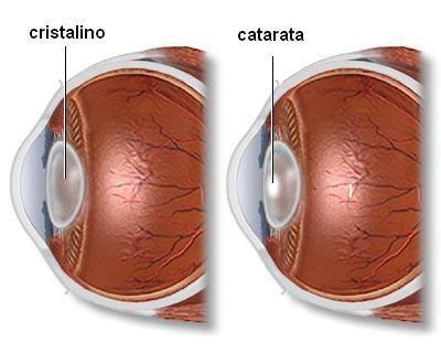 Catarata: A catarata é definida como qualquer opacificação do cristalino que, acarrete a diminuição da visão. As alterações podem levar, desde a pequenas distorções visuais, até à cegueira.