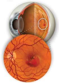 A DMRI causa baixa visão central (mancha central) trazendo enorme comprome mento da qualidade de