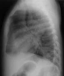 Malformações bronco-pulmonares Cisto congênito do pulmão Malformação de difícil diagnóstico diferencial com malformação adenomatóide cística, especialmente a tipo 1, com apresentação de cistos no