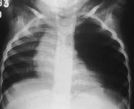 132 Sequestração pulmonar Apresenta como fisiopatologia a formação de um broto pulmonar acessório, sem conexão com a árvore traqueobrônquica.