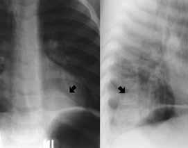 A drenagem venosa do SIL é feito pelas veias pulmonares e, do SEL, pelas veias sistêmicas.