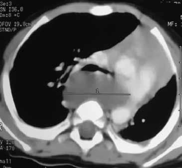 Com relação ao diagnóstico, a radiografia de tórax da SEL apresenta-se como uma massa tumoral no mediastino e da SIL, como uma imagem sólida ou cística no lobo