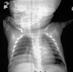 Malformações bronco-pulmonares hiperinsuflação exagerada do lobo, com distensão de alvéolos e mínima destruição de septos interalveolares (que
