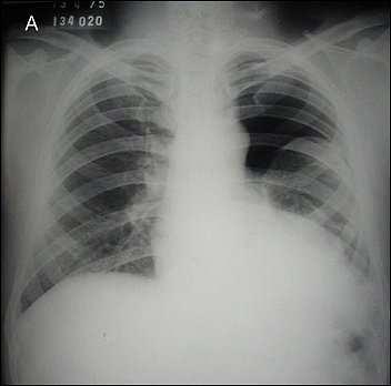 Figura 2. Pneumotórax ocupando todo o terço superior do campo pleuropulmonar a esquerda (A).