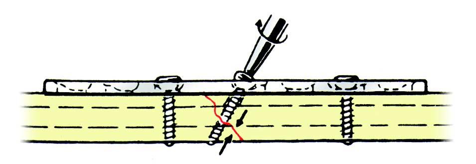 Placa de Suporte (Escora) Urna das aplicações mais comuns da fixação com parafuso de compressão é na reconstrução de fraturas epifisárias e metafisárias.