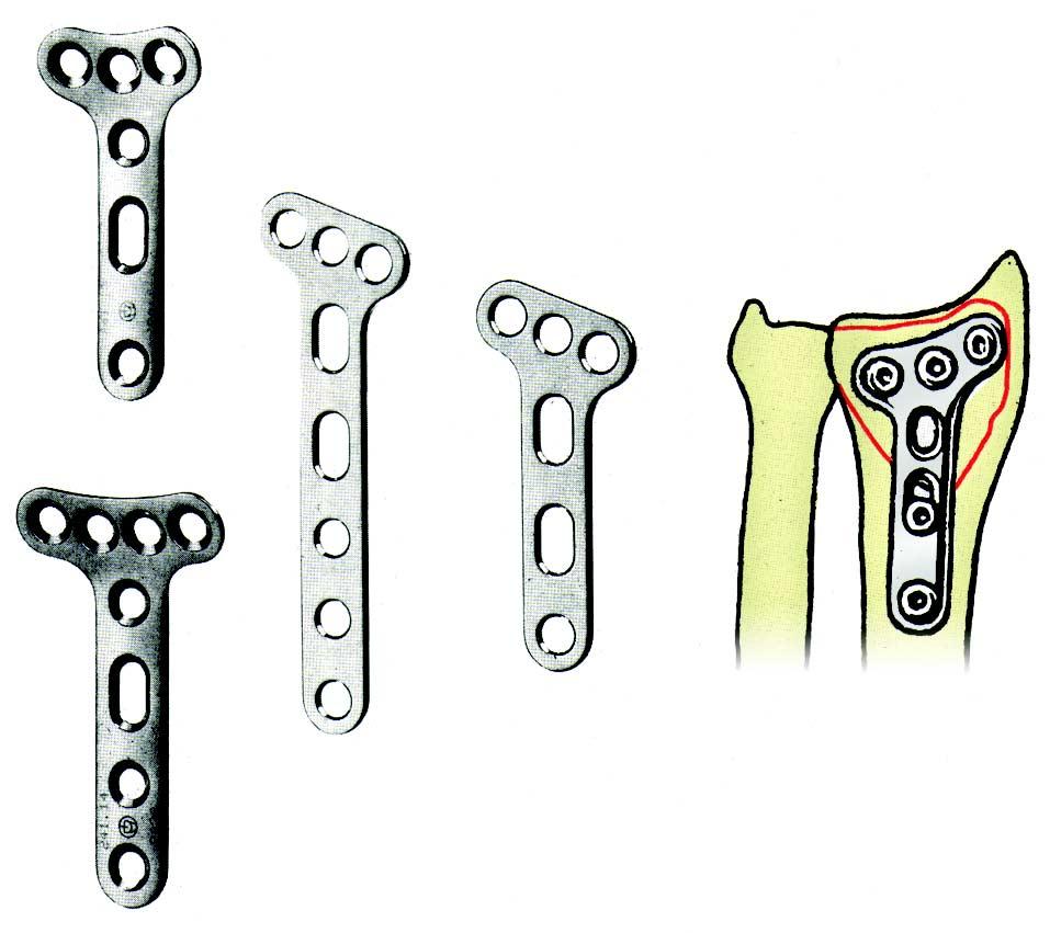 Placas devem ser consideradas apenas se parafusos puderem ser ancorados com segurança nos fragmentos distais.