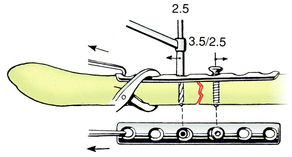 Técnica de Implantação Um furo de broca de 2,5 mm é feito num fragmento a 1 cm da fratura.