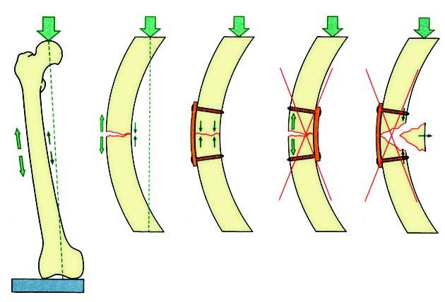 Ocasionalmente uma fratura pode ser estabilizada por parafusos de compressão unicamente, mas na maioria dos casos a fixação com parafusos de compressão tem que ser suplementada por uma ou mais
