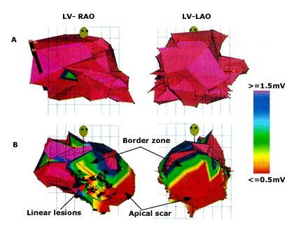 Figura 2 - Sistema de mapeamento tridimensional Carto mostrando mapa de ativação ventricular em paciente normal A e