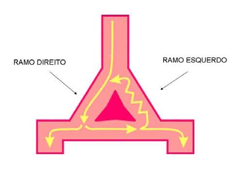 Figura 2 - diagrama do circuito de reentrada durante TVRRR com rotação anti-horária, que é encontrado mais frequentemente, originando padrão de BRE no