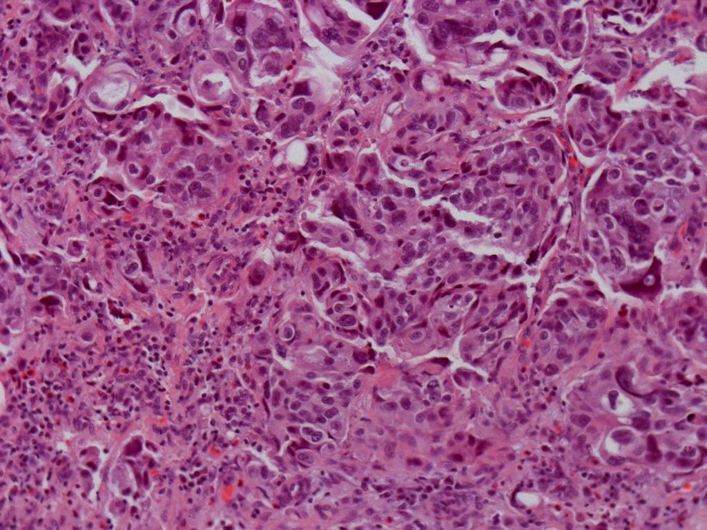 RTU vesical: Carcinoma urotelial Alto-grau, pt1 (?) (Biópsia superficial). Restantes biopsias vesicais sem CIS ou tecido neoplásico.