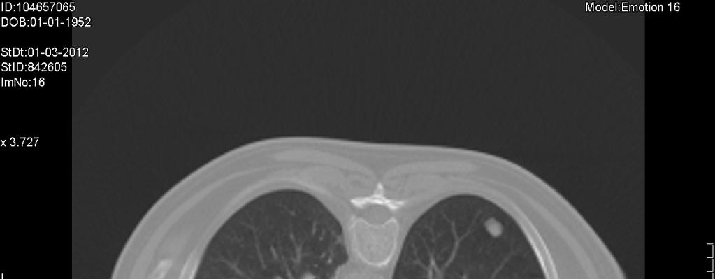 J.J.V.R, 60 anos. História Clínica: 2010 - Hematuria -> cistoscopia tumor. 10/2010 - "carc urotelial superficial alto grau.