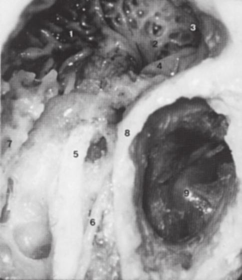 16) é um recesso situado sob a eminência piramidal e estende-se do limite posterior da 7 5 8 5 3 1 6 9 4 7 2 6 FIGURA 1.13 Cavidade mastóidea direita. (1) Antro mastóideo.