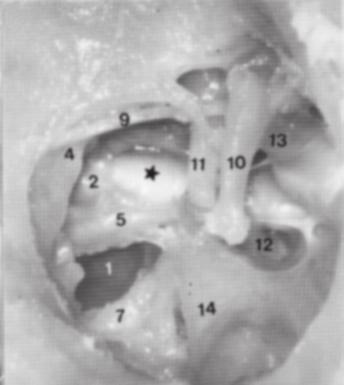 a margem superior da janela coclear. O soalho do seio timpânico corresponde à ampola do canal semicircular posterior do ouvido interno.