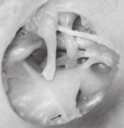 18 Vista da cavidade timpânica esquerda após remoção da membrana. (1) Promontório. (2) Fóssula da janela da cóclea (janela redonda). (3) Subículo do promontório. (4) Pontículo do promontório.