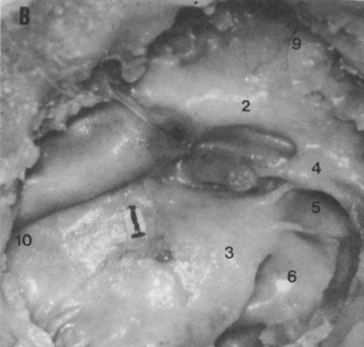 promontório e o nervo facial que protrui do canal deiscente. (1) Estribo. (2) Proeminência do canal facial com o nervo facial. (3) Promontório. (4) Eminência piramidal. (5) Seio timpânico.