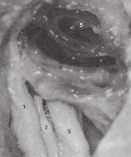 31 Cóclea membranácea e meato acústico interno esquerdos. (1) Nervo facial. (2) Nervo vestibular. (3) Nervo coclear. (4) Giro basal da cóclea. (5) Giro apical.