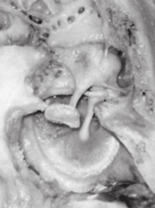 3 1 10 6 9 FIGURA 1.9 Vista interna da membrana timpânica e dos ossículos articulados. (1) Superfície óssea da fossa média do crânio. (2) Parede óssea do teto da cavidade timpânica.