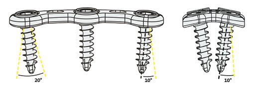 semi-restrito permite uma melhor distribuição de carga Instrumentos ergonomicamente concebidos para implantação simplificada Placas com