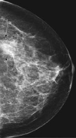 Tomossíntese Digital da Mama Mamografia