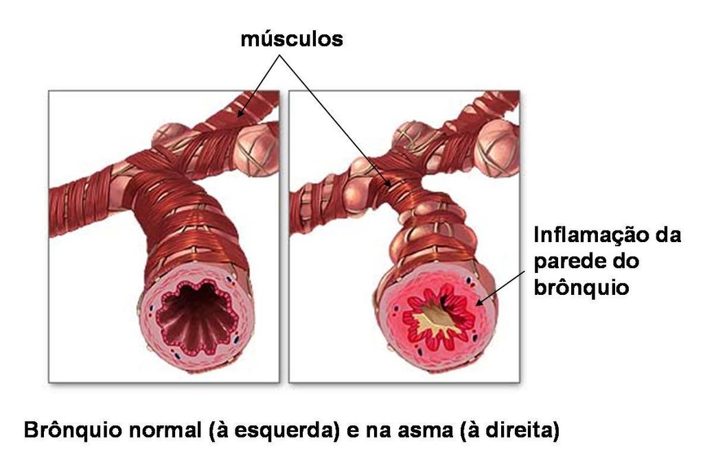 ASMA Doença aguda e reversível que ocorre devido ao broncoespasmo resultante de alérgenos, infecções e