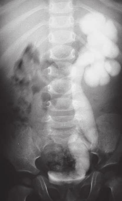 UROLOGIA FUNDAMENTAL INTRODUÇÃO O termo megaureter foi utilizado pela primeira vez por Caulk, em 1923, para descrever o caso de uma mulher com ectasia ureteral distal sem a proporcional dilatação da