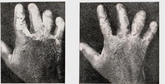 240 Especial interêsse em relação ao assunto desperta sem dúvida o magistral trabalho de Gillies e Cuthbert, intitulado: "Plastic surgery of the hand".