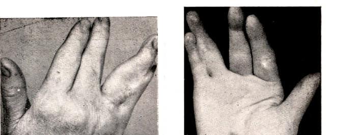 anos. Os dedos foram separados por dissecção, resultando